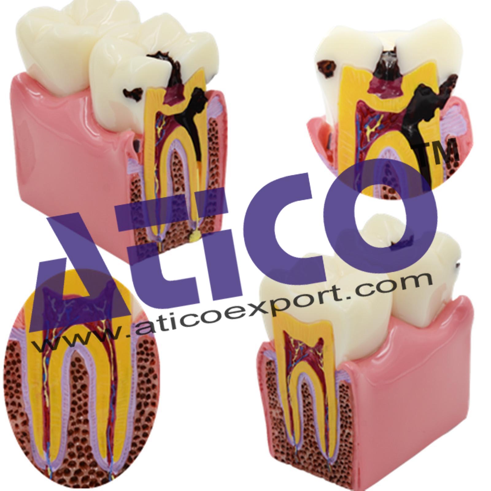 Dental Caries Model