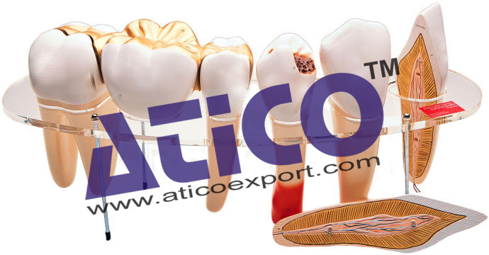 Human Teeth Model - Dental Problems