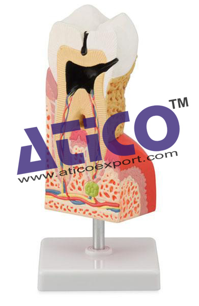 Lower Molar With Caries