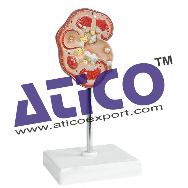 Pathological Model Of Renal Calculus