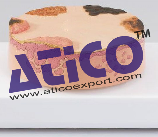 Skin Cancer Model